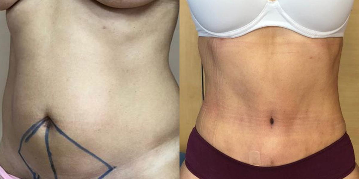 Abdominoplastia antes y después de la cirugía.